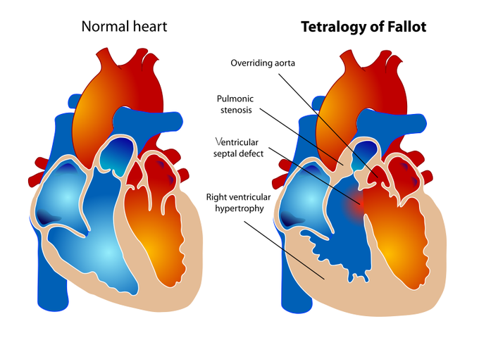 Fallot's tetralogy