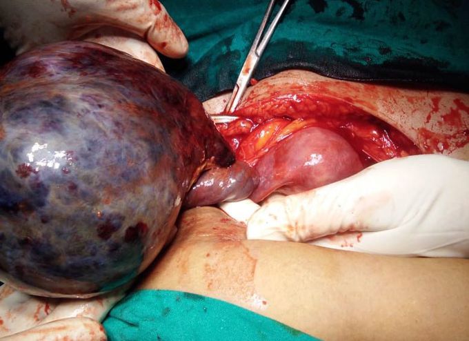 Torsion of ovarian cyst