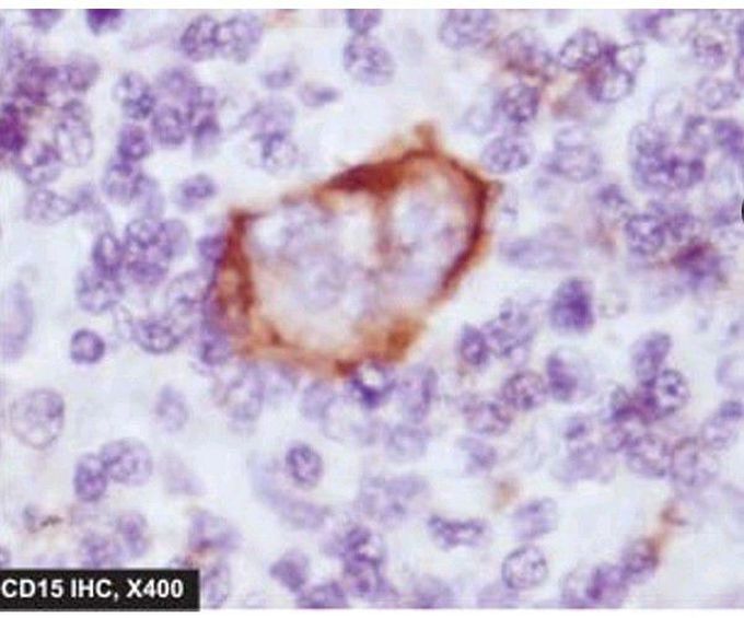 Reed sternberg cell