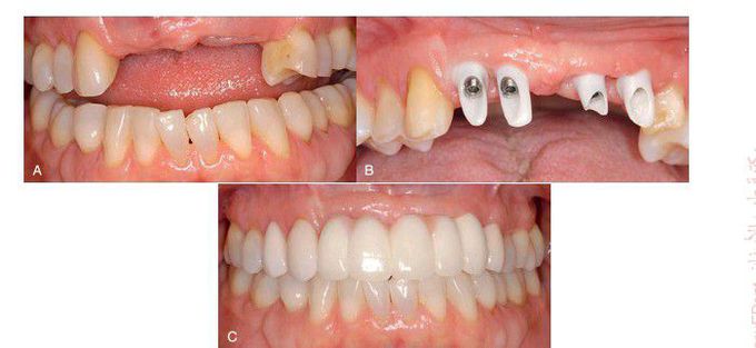 Replacement of five anterior maxillary teeth