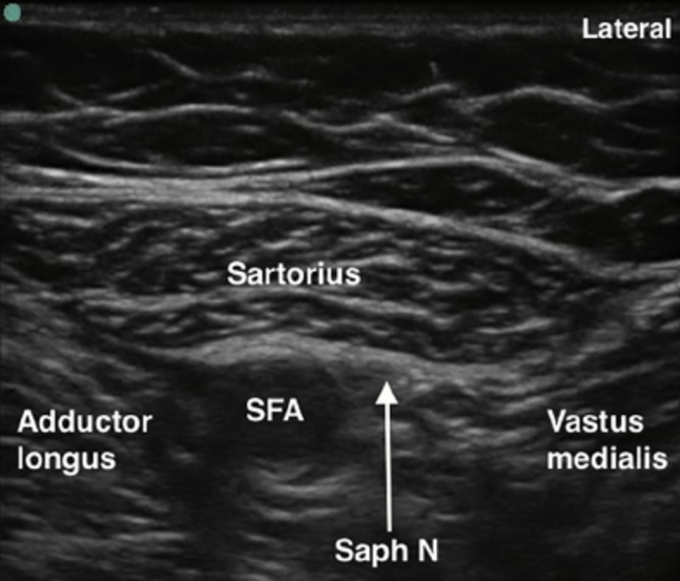 Ultrasound of the Adductor Canal