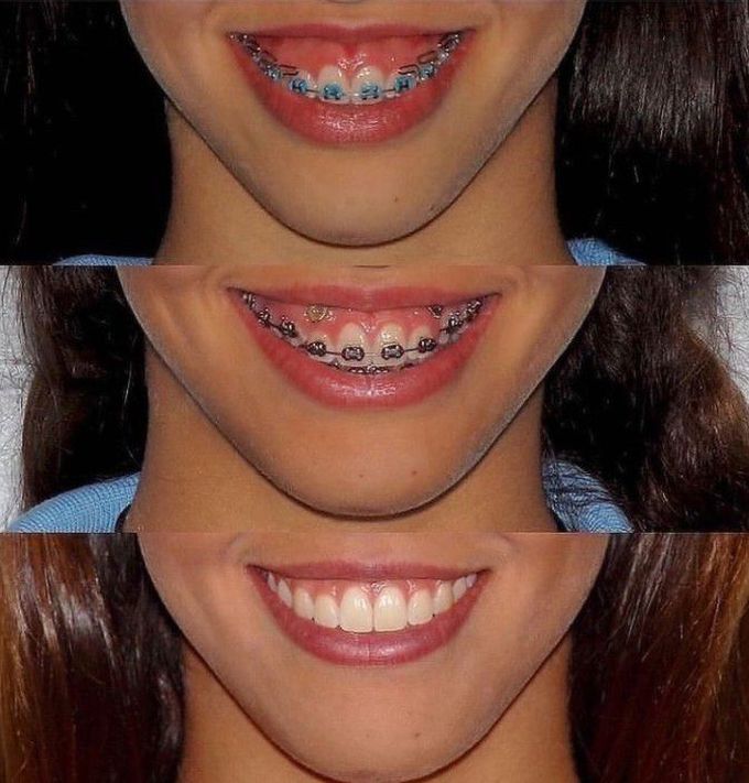 The magic of Tads and Braces