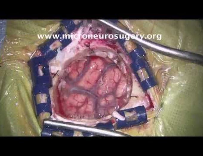 Brain Surgery:  Meningioma Left Temporal Lobe