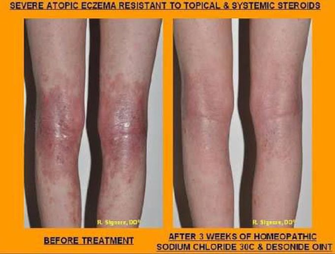 Eczema treatment