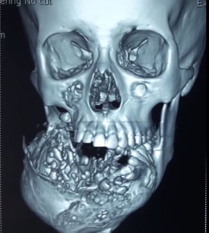 Mandibular tumor