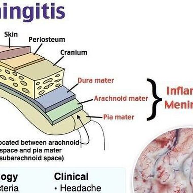 Meningitis