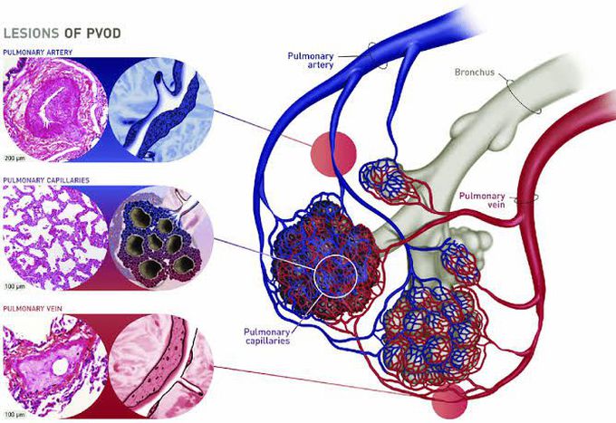 Veno occlusive disease