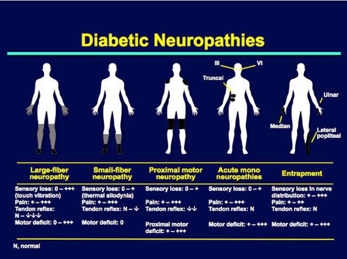 Diabetic Neuropathies