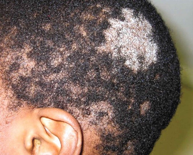 The tinea capitis