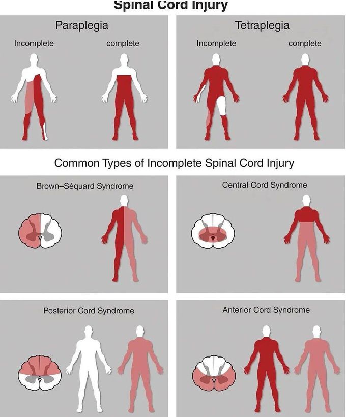 Spinal Cord Injury