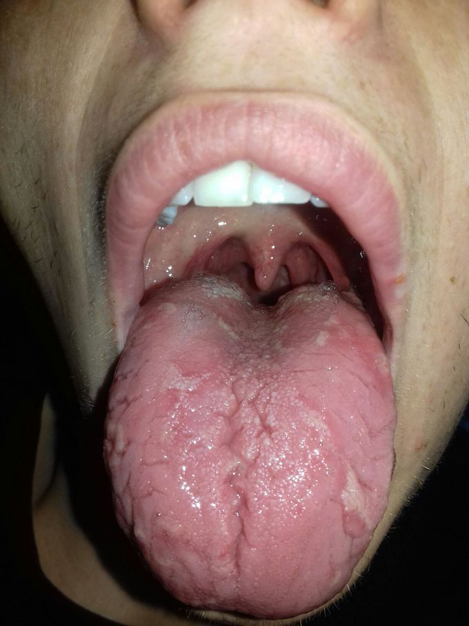 is something wrong here? this guy claims that his tounge looked like this his whole life.