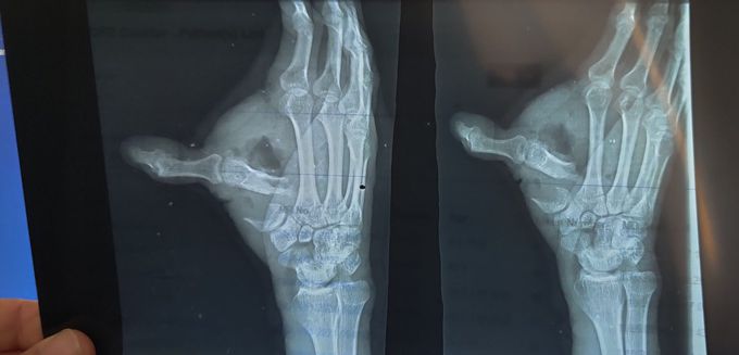 Traumatic injury to hand with fracture and dislocation of 1st metacarpal
