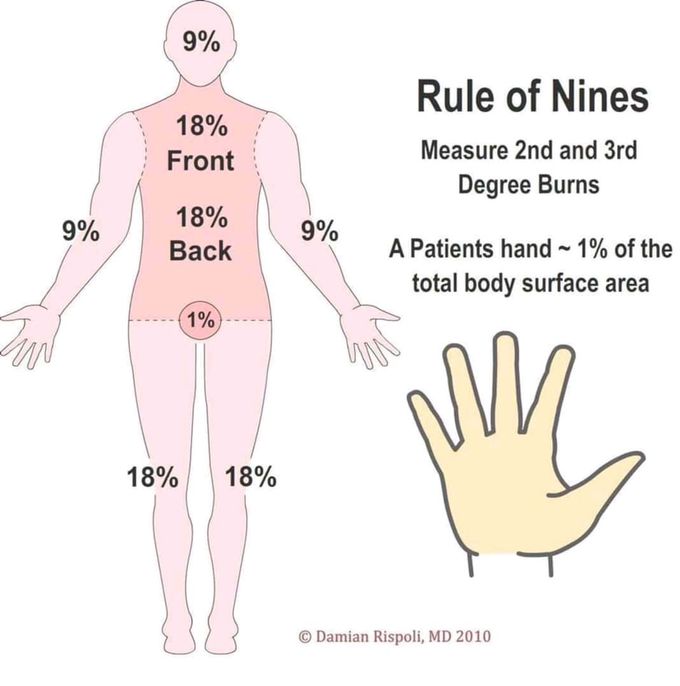 Rule of nine in burn cases