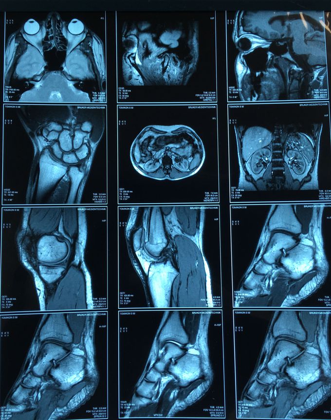 MRI or CT?