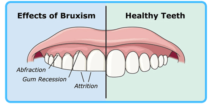 Bruxism