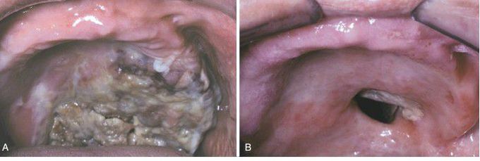 Extranodal NK/T-Cell Lymphoma, Nasal-Type