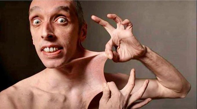Real photo of a person suffering from Ehler's danlos syndrome