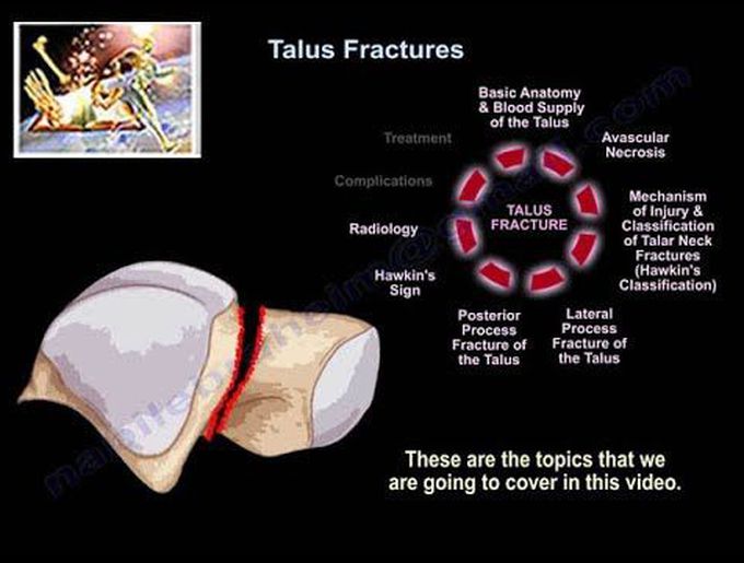 Talus Fractures - Everything You Need To Know - Dr. Nabil Ebraheim