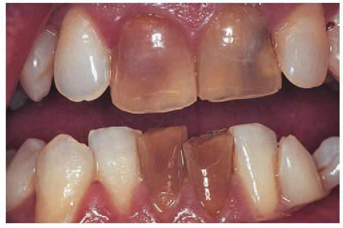 Non vital incisor teeth