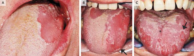 Geographic Tongue