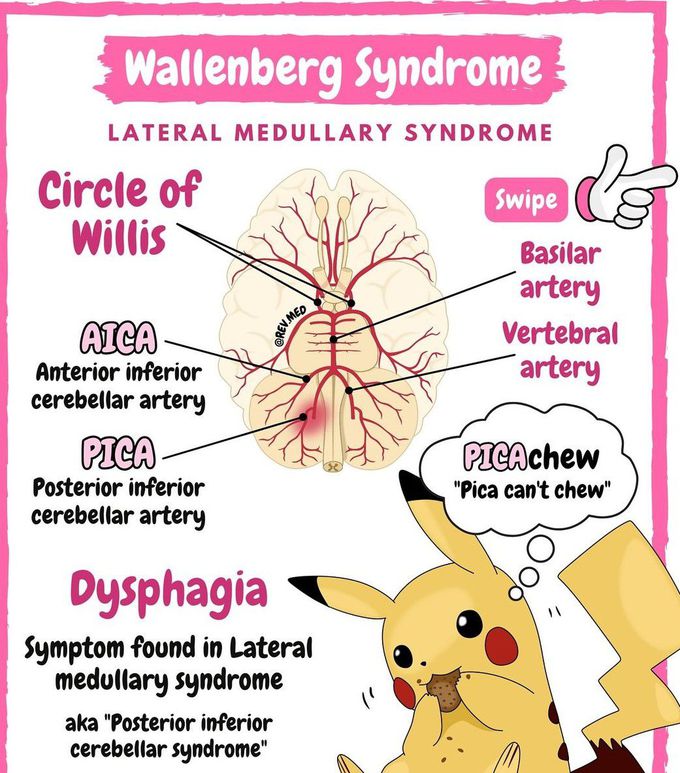 Wallenberg Syndrome I