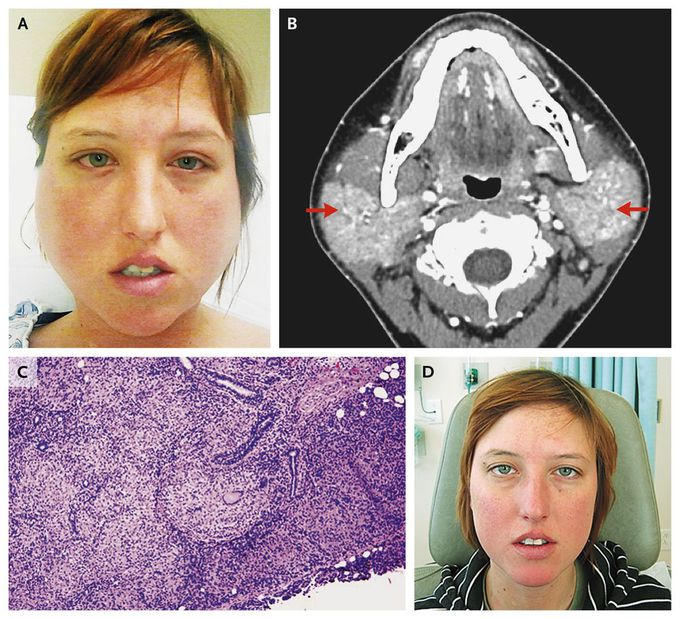 Heerfordt's Syndrome, or Uveoparotid Fever