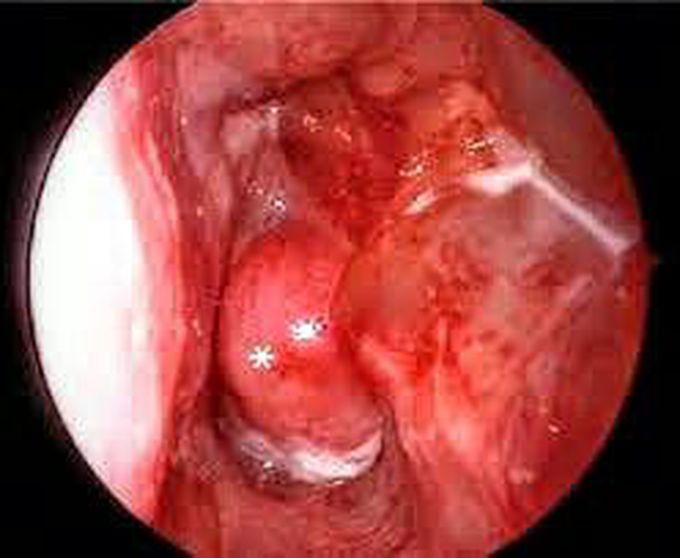Nasopharyngeal angiofibroma !