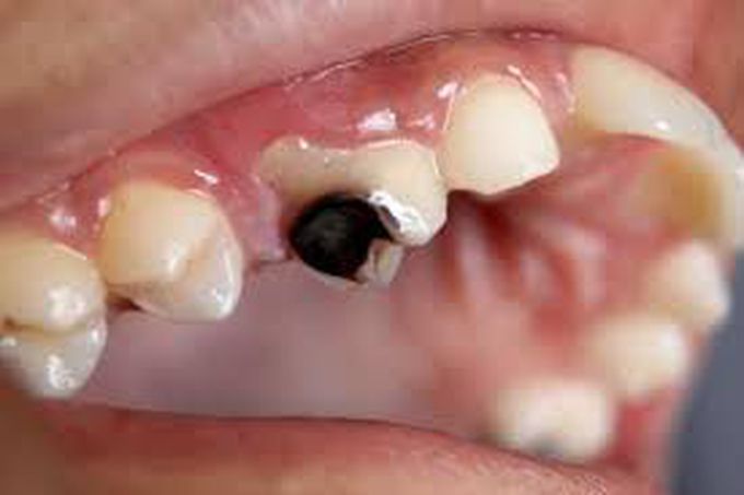 How to get rid of dental decay?