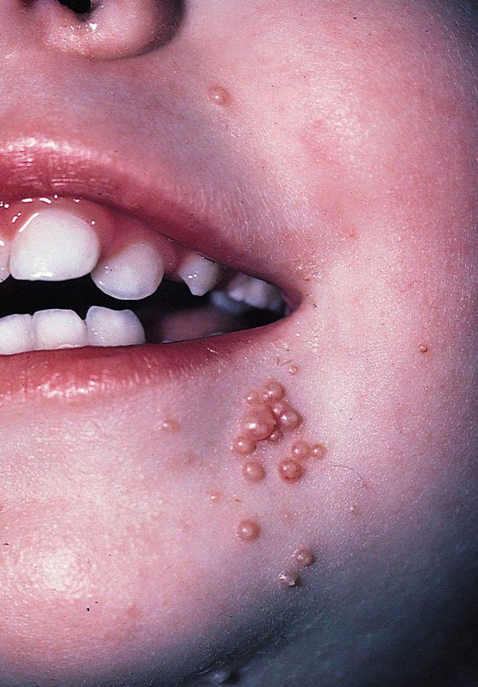 Molluscum Contagiosum