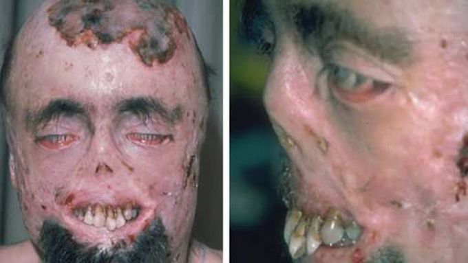 Porphyria