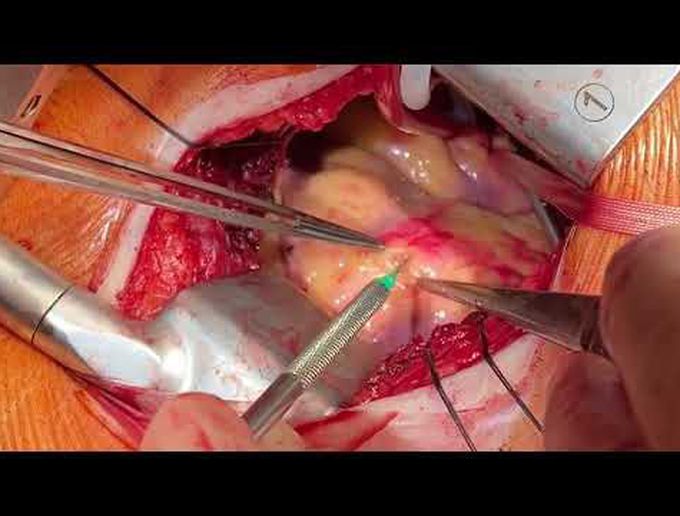 Minimally Invasive Myocardial Bridge Unroofing