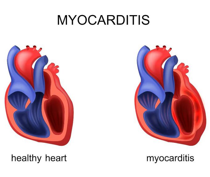 Myocarditis