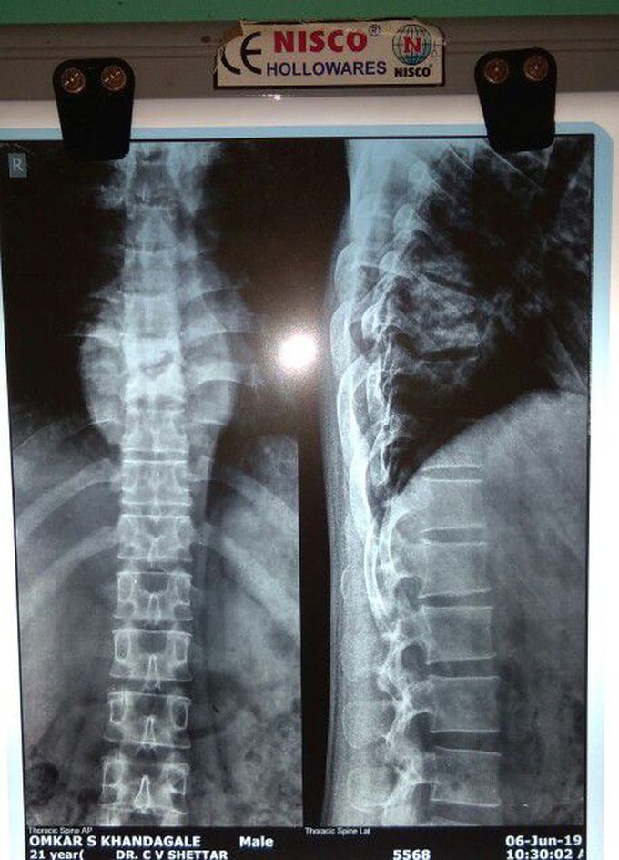 Potts spine xray