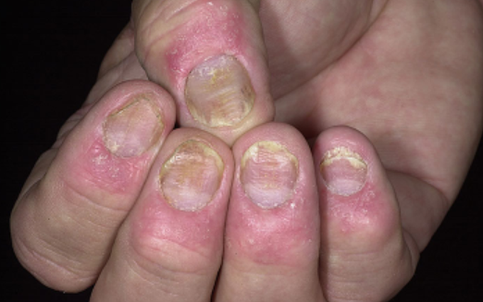 Disease diagnosis