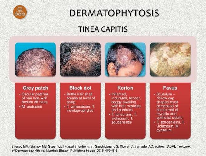 Varieties of Tinea Capitis