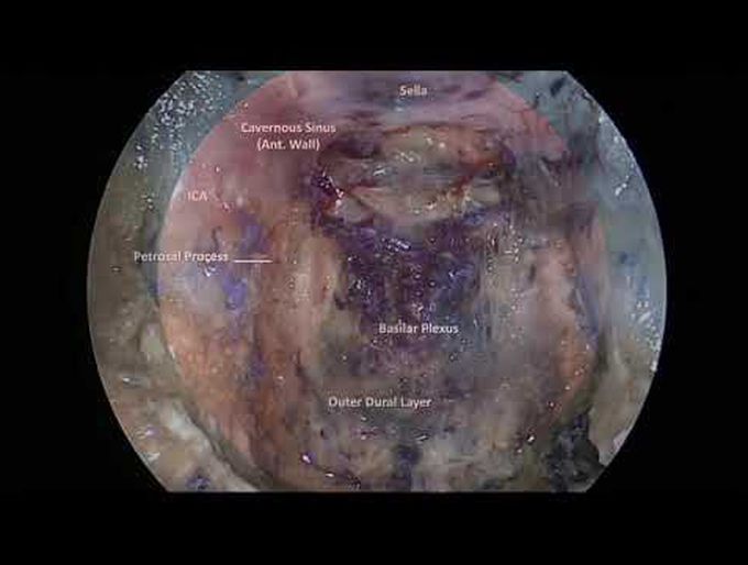 Endoscopic endonasal approach for resection of pediatric chordoma with brainstem invasion