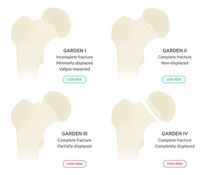 Garden Classification of Intra-articular Femoral Fracture