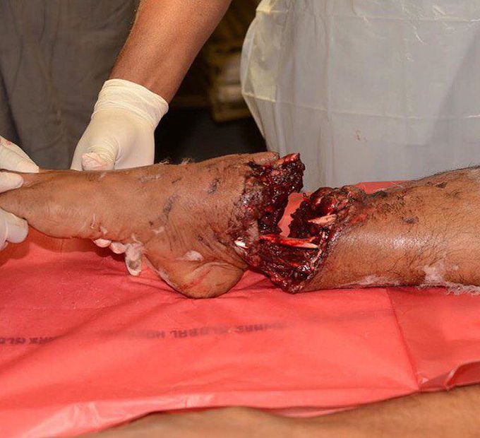Subtotal amputation of right lower limb