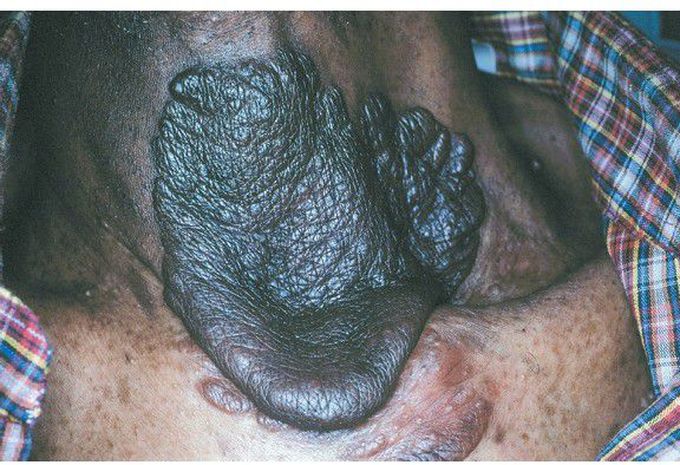 Neurofibromatosis Type I.