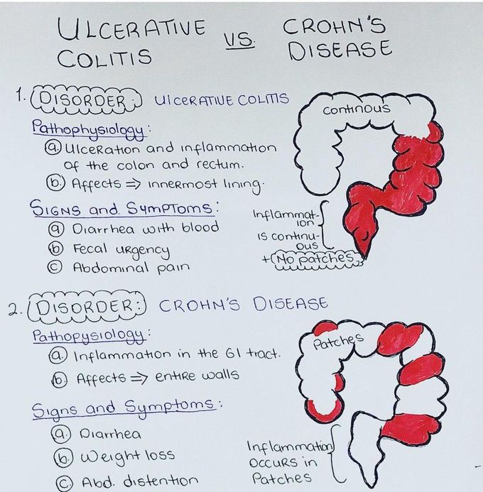 Ulcerative Colitis Vs Crohn's Disease