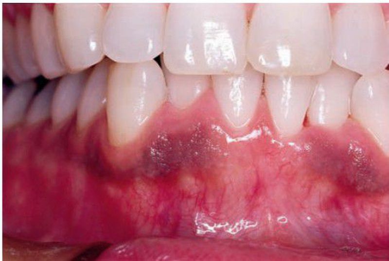 tobacco melanosis Smoking associated melanosis