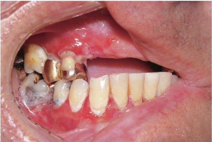 Mucous membrane pemphigoid