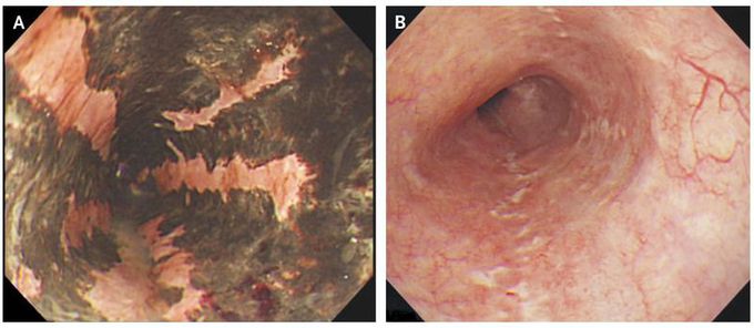 Acute Esophageal Necrosis
