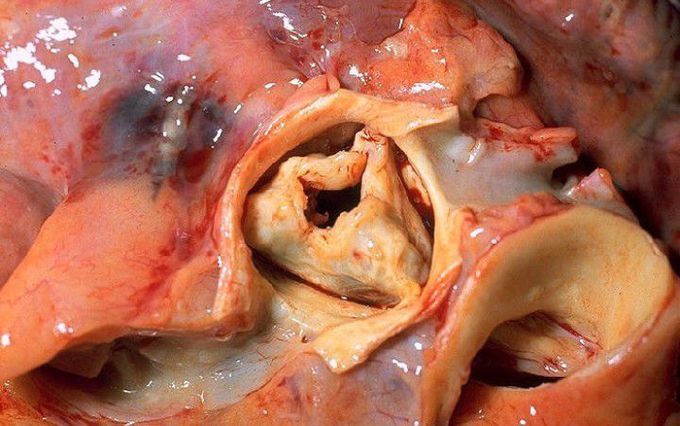 Rheumatic heart disease