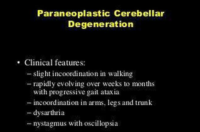 These are the clinical features of Paraneoplatic cerebellar syndrome