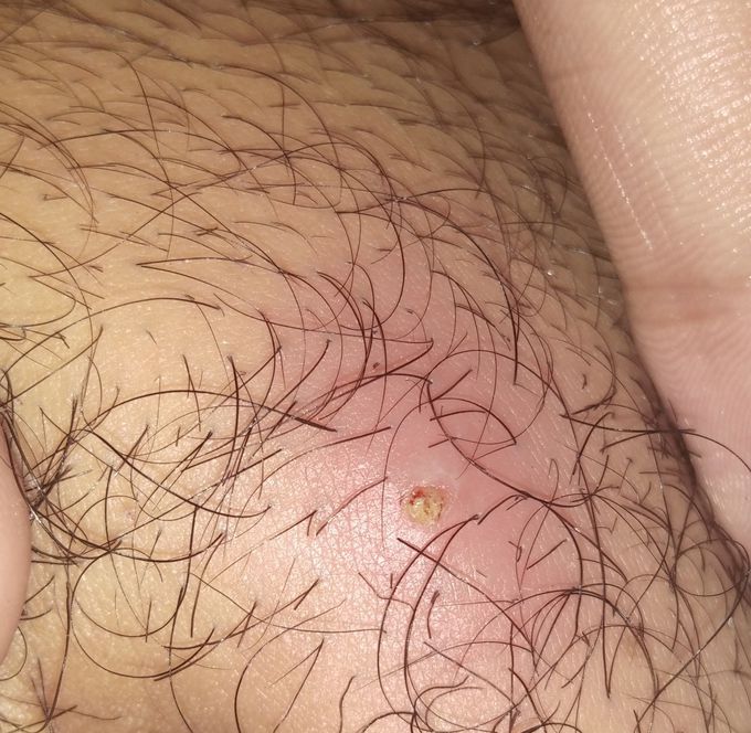 This pus pimple formed below navel causing pain