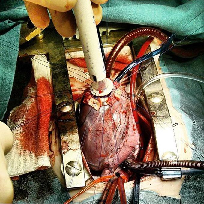 LVAD