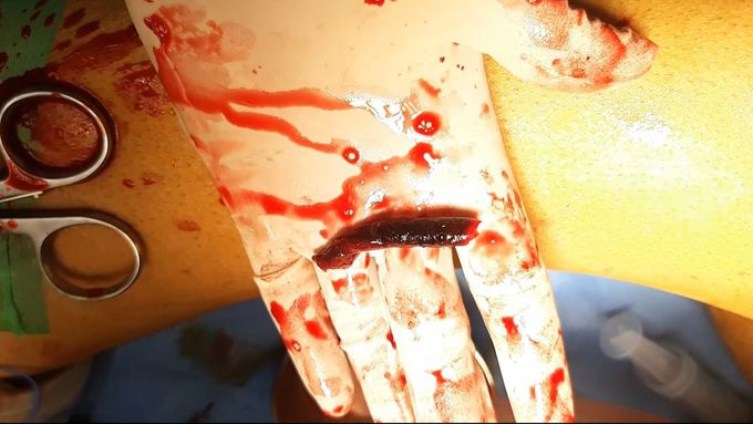 Clot Retrieved from the External Iliac Artery