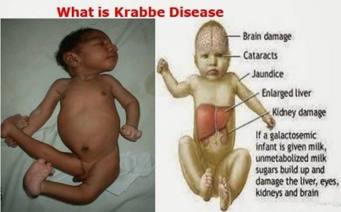 Symptoms of Krabbe's disease