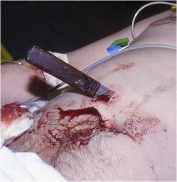Penetrating Trauma